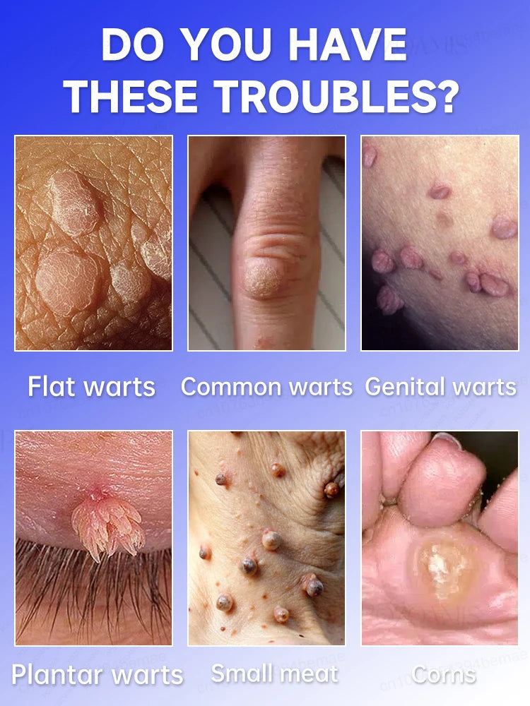 Skin Tag Removal