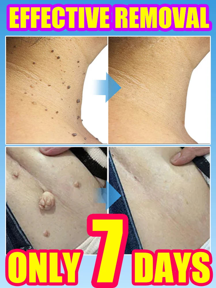Skin Tag Removal