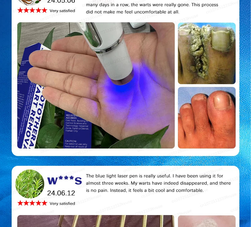 Skin Tag Removal