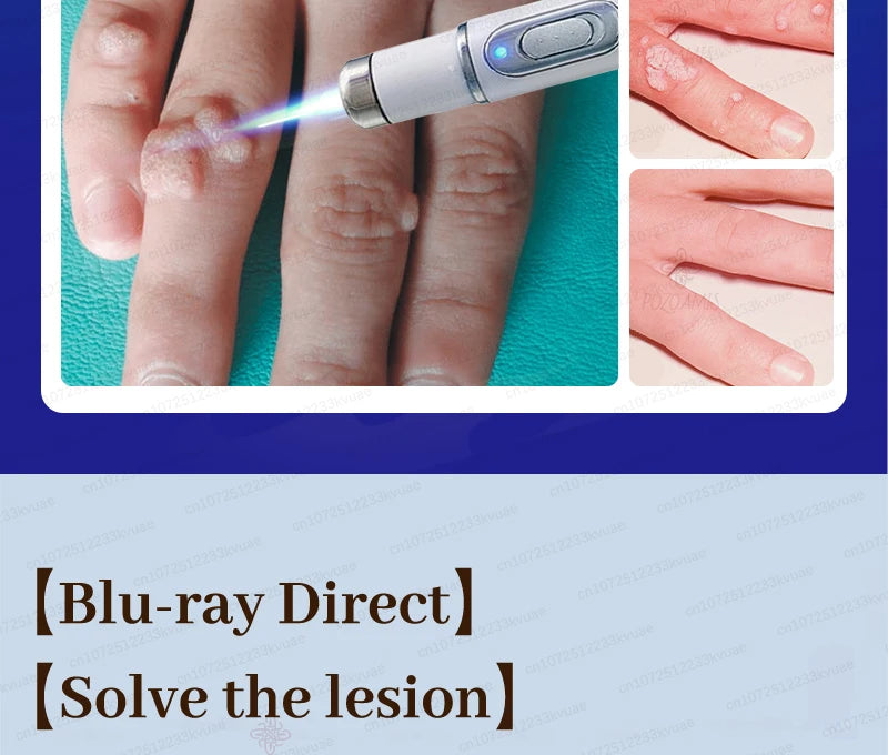 Skin Tag Removal