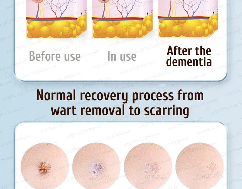Skin Tag Removal
