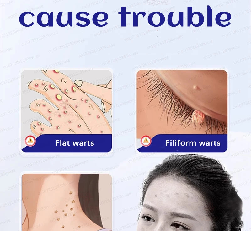 Skin Tag Removal