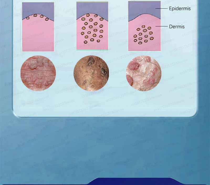Skin Tag Removal