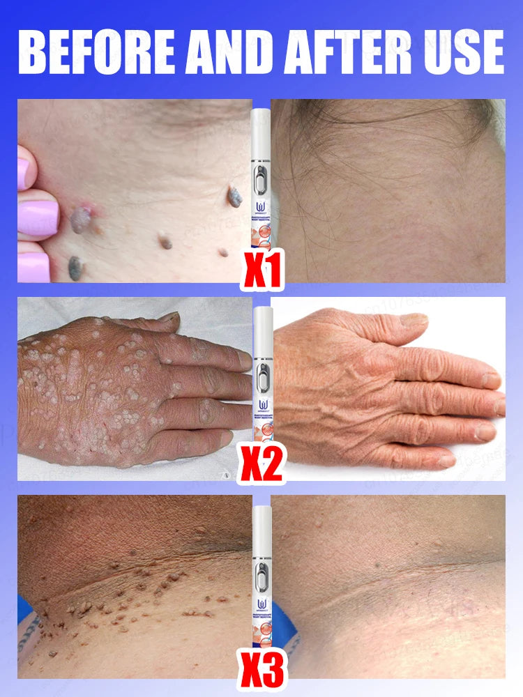 Skin Tag Removal
