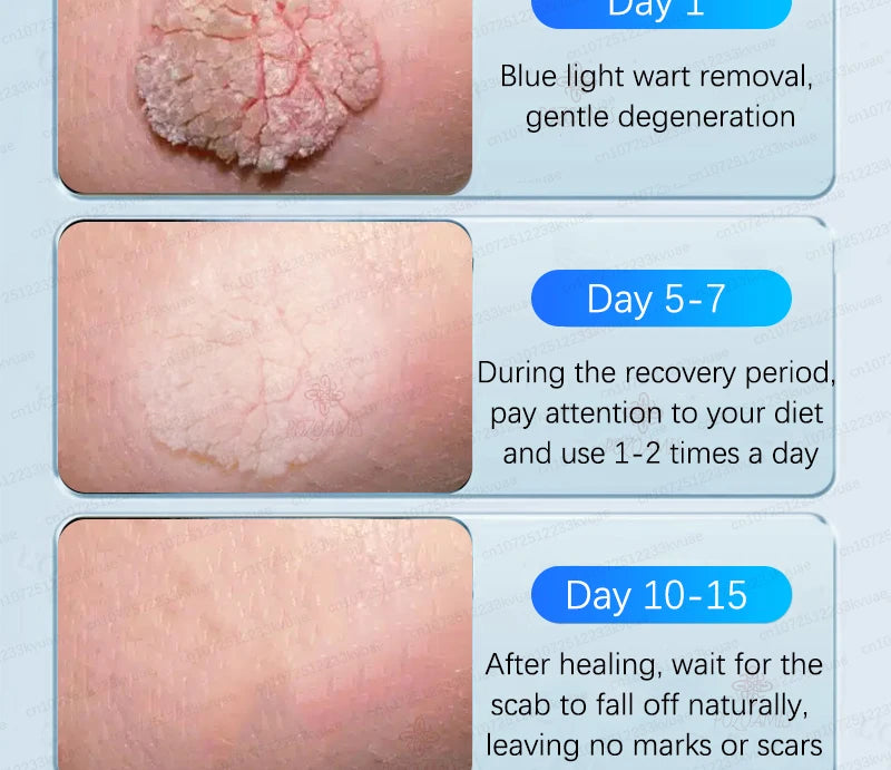 Skin Tag Removal