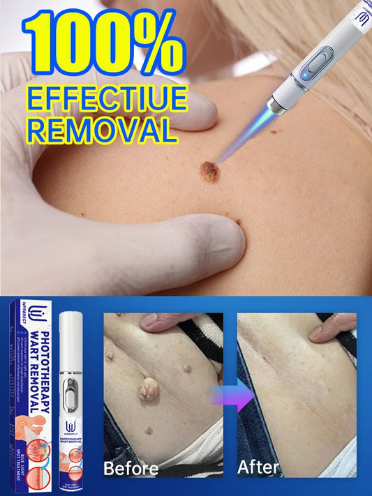 Skin Tag Removal