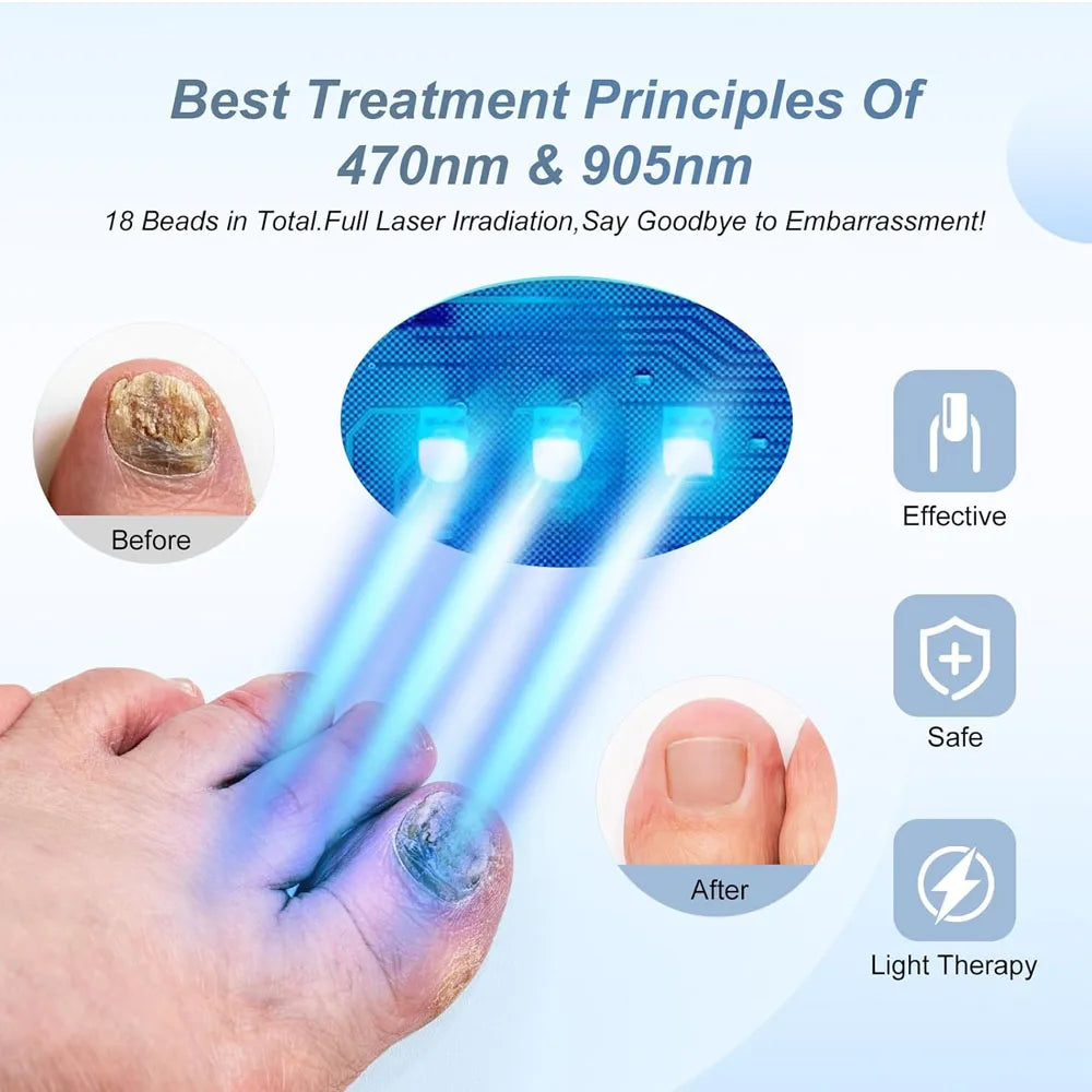 Fungal Nail Laser Device Repair