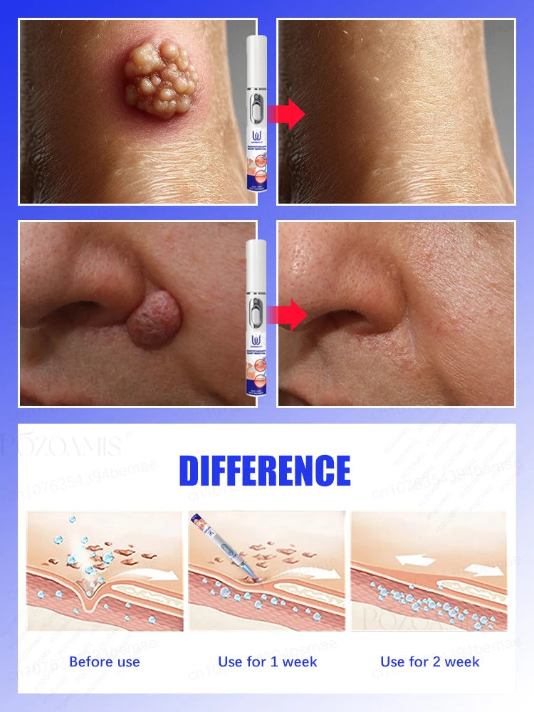 Skin Tag Removal